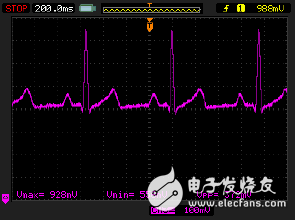 監(jiān)護儀模擬輸出端顯示出從電力線耦合而來的噪聲