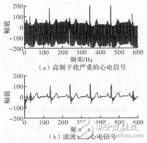 心電信號(hào)檢測中濾除肌電干擾的方法解析